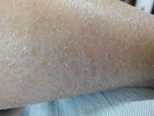 皮肤干燥的人怎么预防皮肤过敏？
